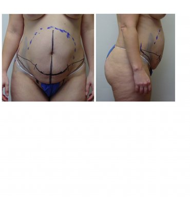 abdominoplasty without umbilical scar